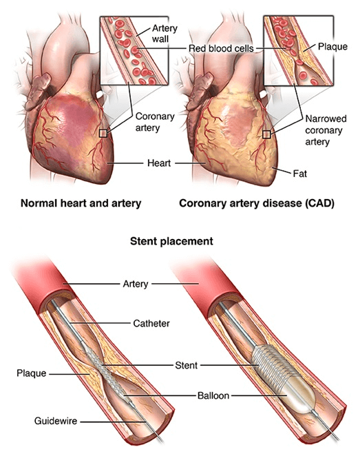 Stent Coronary Angioplasty